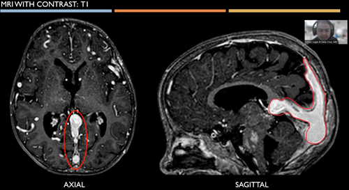 Endovascular Management of a Mural Type of Vein of Galen Malformation in a 5-year old, Filipino child with Seizures: A Case Report